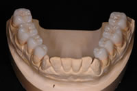 セラミックス治療