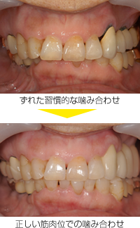 噛みあわせの比較